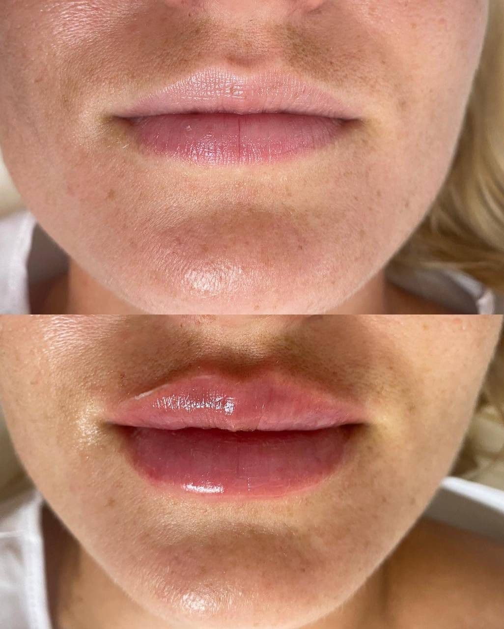 Botox results - Face