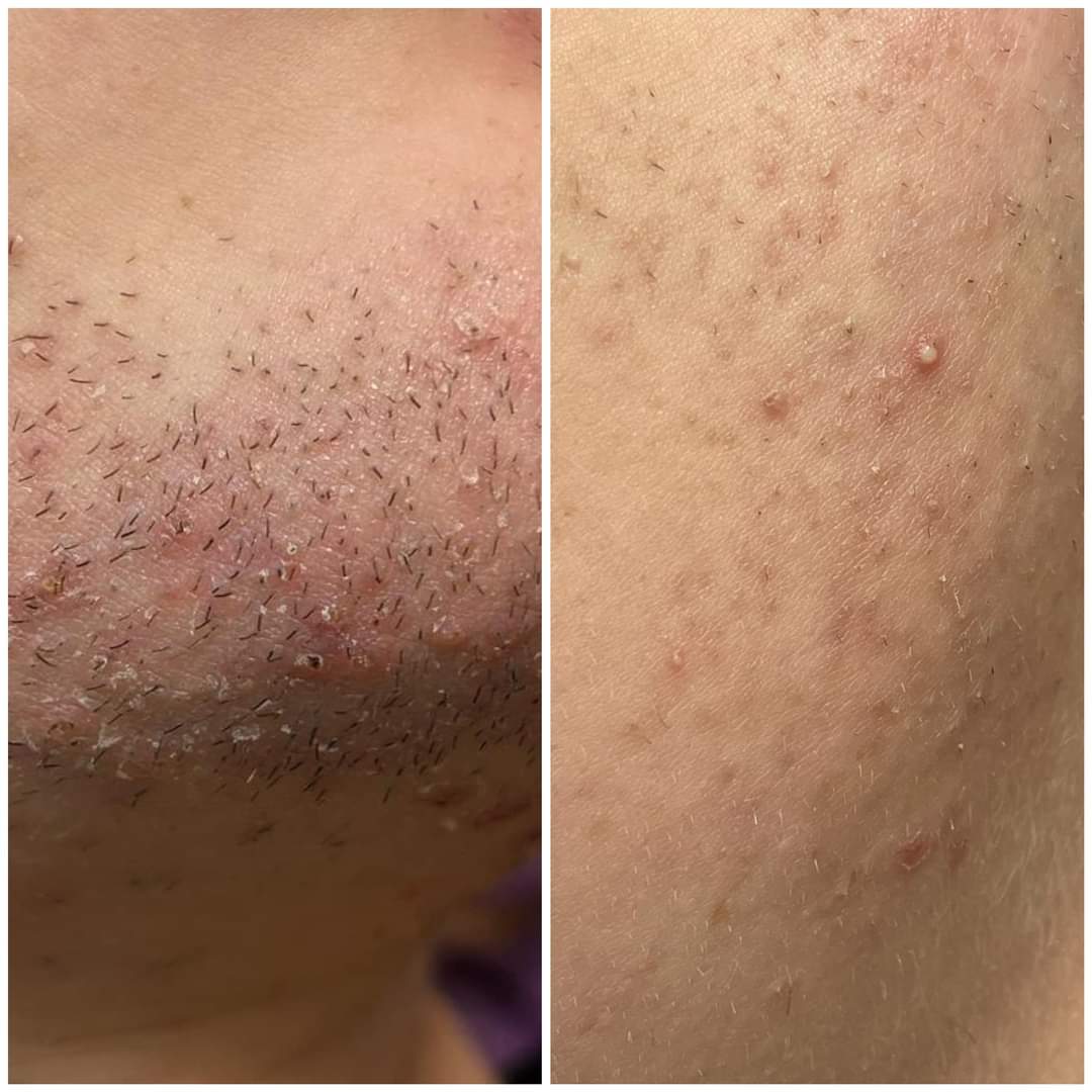Hair Removal Laser results - Treatment Area
