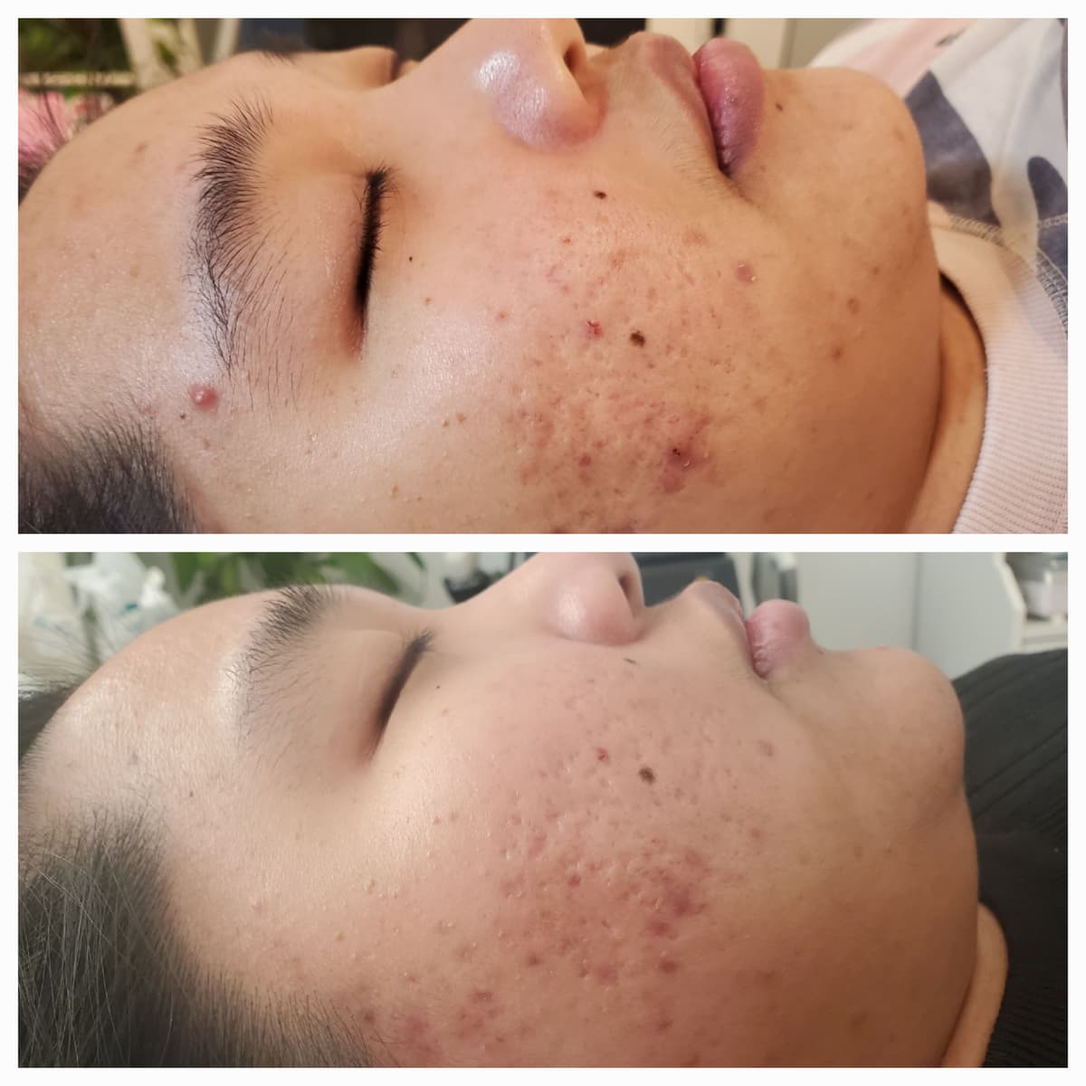 Chemical Peel results - Face